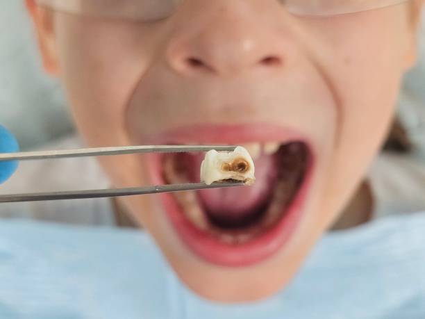 Best Emergency Treatment for Dental Infections or Abscesses in Oracle, AZ